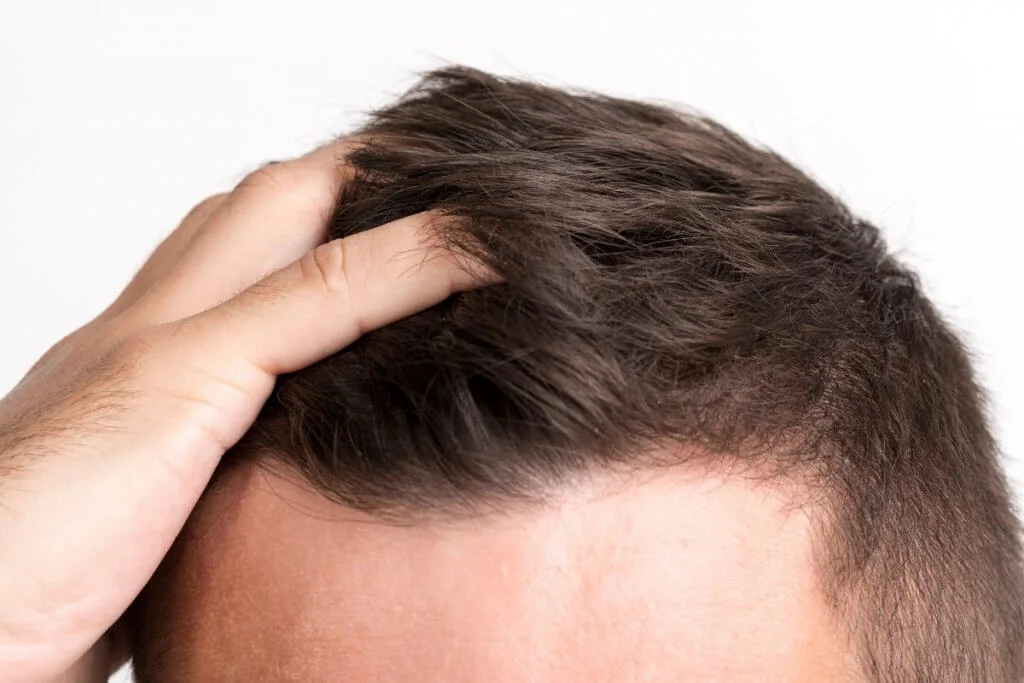 Queda De Cabelo